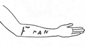 Illustration of telepathic 'skin-writing' by Olga Kahl. In this example, the word 'Francois', thought but not spoken by a person present, was followed by the letters F R A N appearing as red marks on Kahl's forearm. Illustration of telepathic 'skin-writing' by Olga Kahl. In this example, the word Francois', thought but not spoken by a person present, was followed by the letters F R A N appearing as red marks on Kahl's forearm.